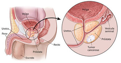 Cáncer de Próstata: en Argentina, representa el 20% de todos los tumores malignos en hombres