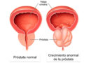 Una nueva era en el tratamiento del cáncer de próstata
